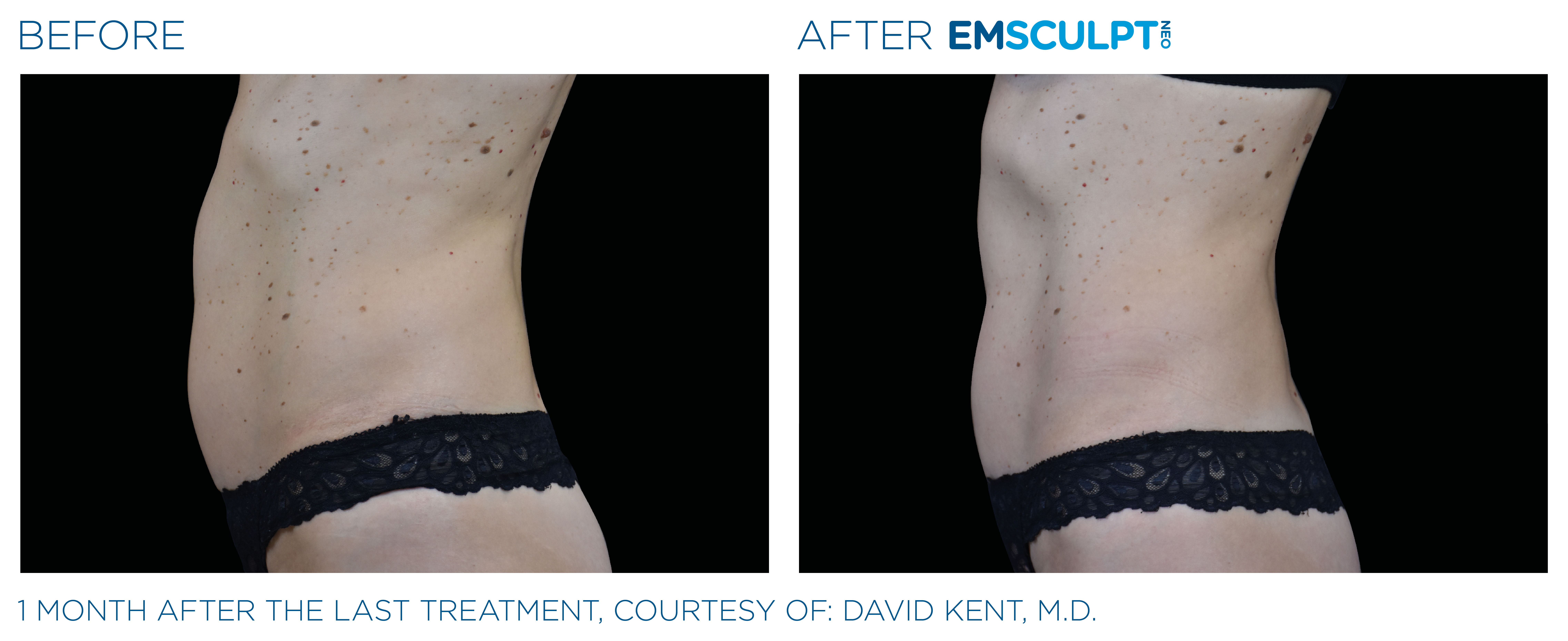 EmSculpt NEO Before and After Female Abdomen