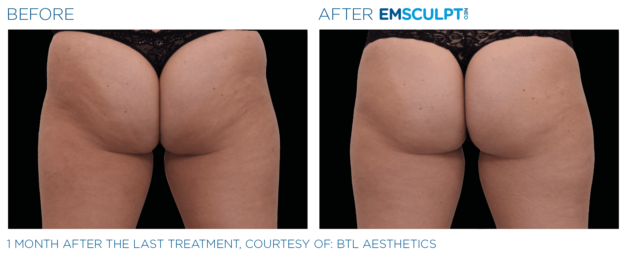 Emsculpt NEO Before and After Female Buttocks