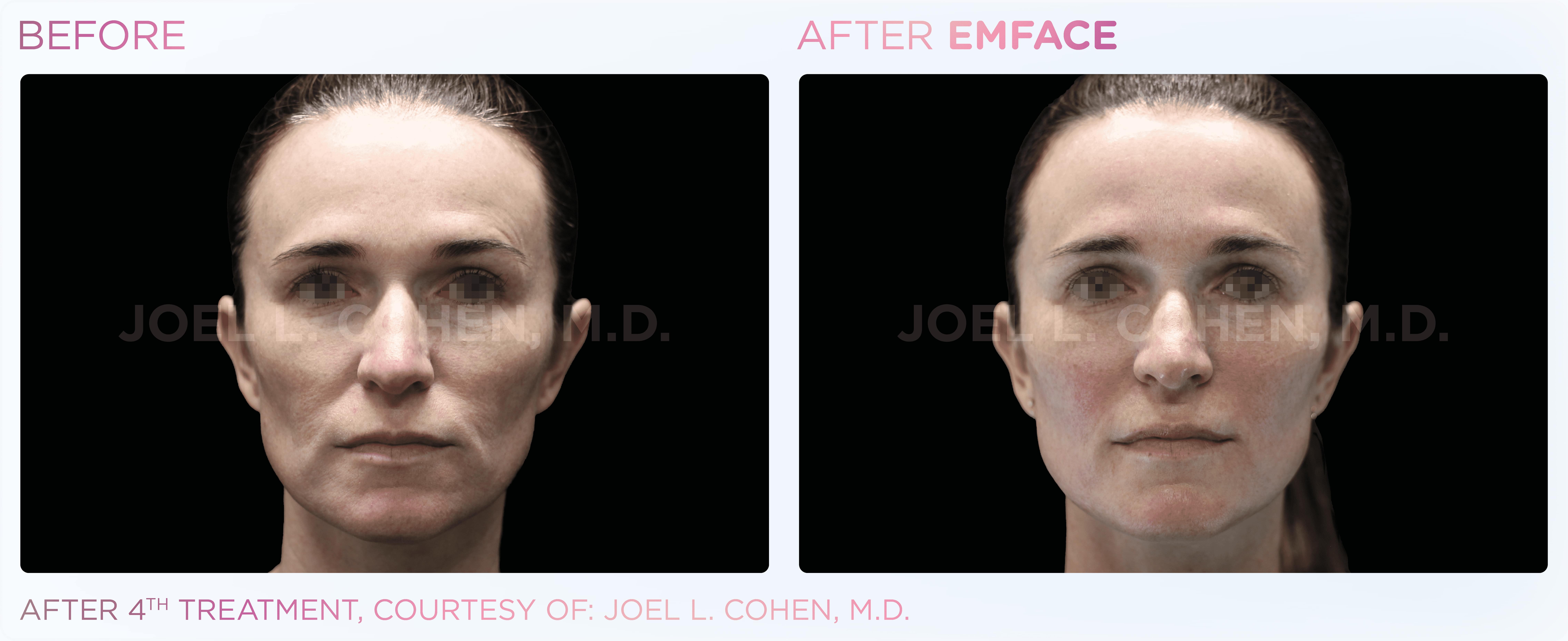 emface