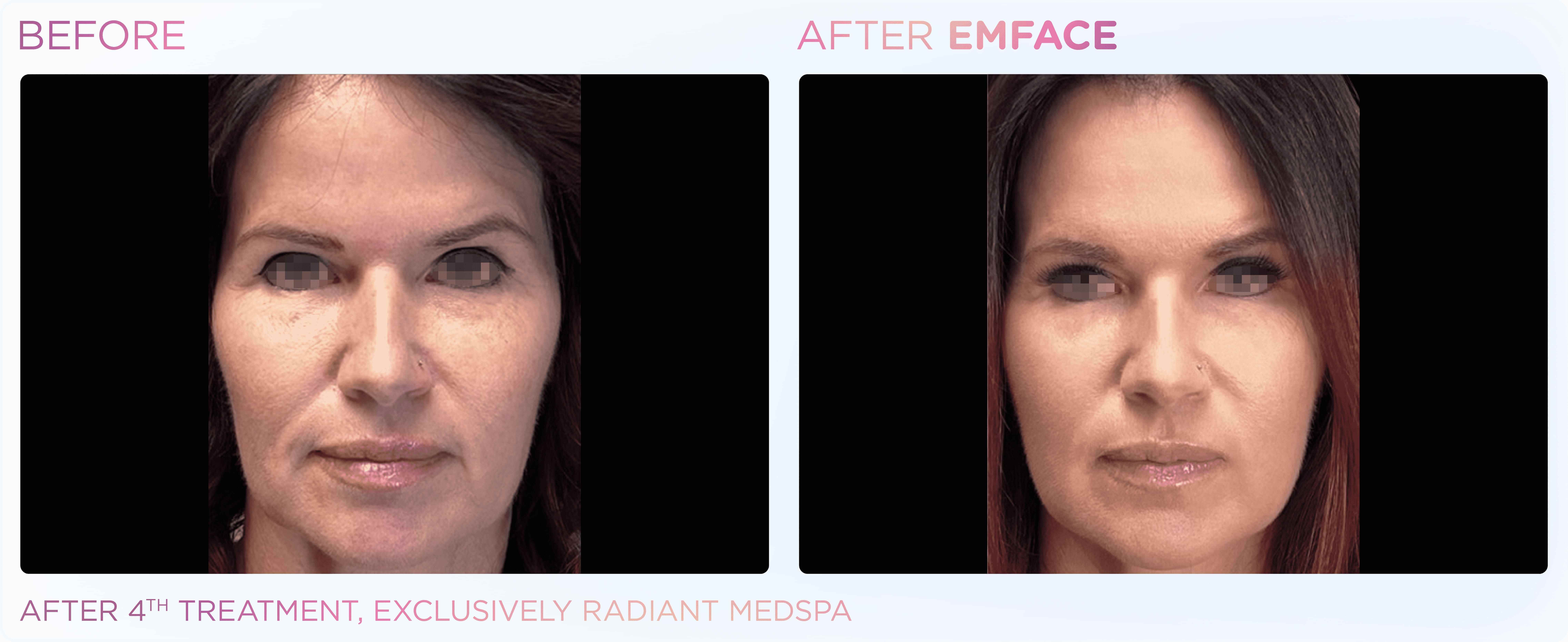 Emface