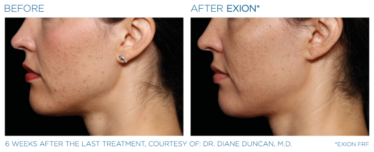 Exion Before and After Female Face